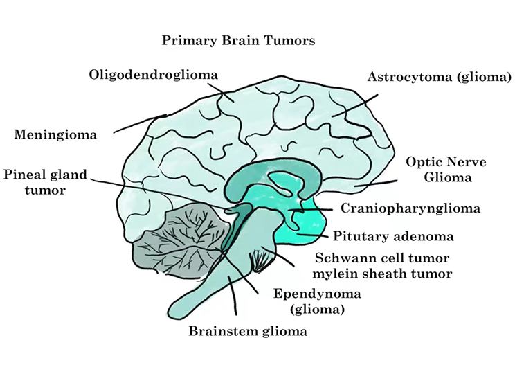 Tumores cerebrales